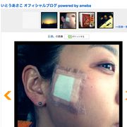 いとうあさこ、顔をやけど!「『女優は顔が命』なのに」…
