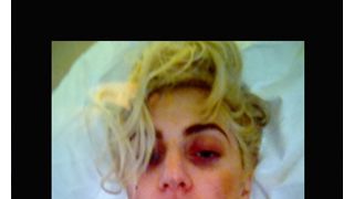 レディー・ガガ、頬のあざをツイッターで公開…痛々しさにファンからは「気をつけて」