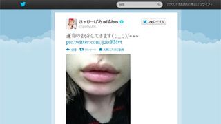 きゃりーぱみゅぱみゅ、顔のキズを公開 抜糸後も傷跡残る……