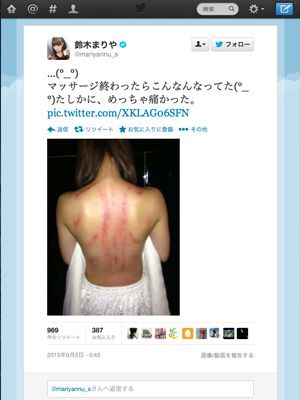 SNH48鈴木まりや、マッサージ痕が「怖い」と話題に…篠田麻里子らも心配