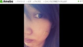 後藤真希、顔のやけどが悪化「ぐじゅ。。っとしてた」