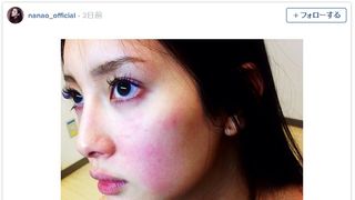 菜々緒、謎の大量発疹を公開…励ましの声に感謝