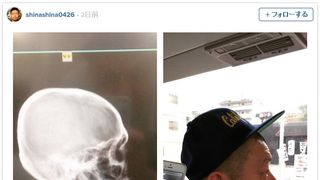 顎出すぎ？ 野性爆弾・川島の“レントゲン写真”に驚きの声