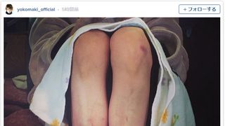 真木よう子、足がアザ傷だらけ！「痛そう」と心配の声