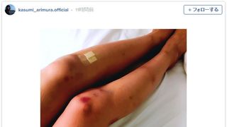 うわ、痛そう… 有村架純、アザだらけの脚に心配の声