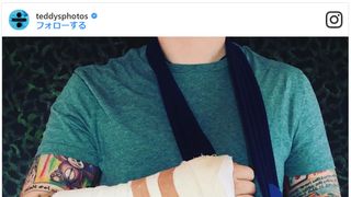エド・シーラン、自転車事故で痛々しい姿…
