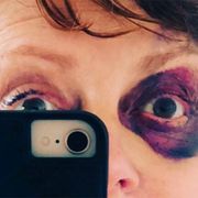 スーザン・サランドン73歳、転倒して鼻を骨折…痛々しい姿に